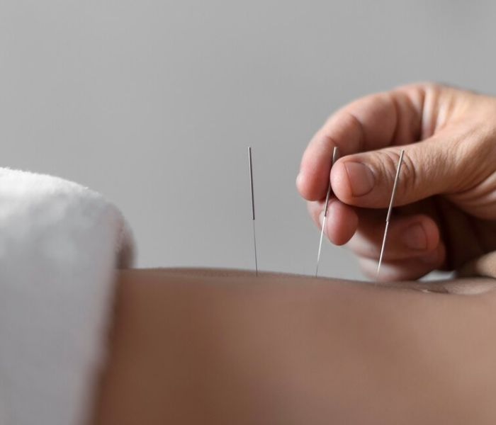 dry-needling-pakenham