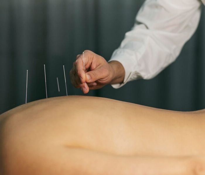 dry-needling-services-pakenham
