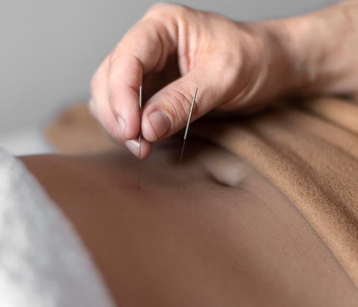 top-dry-needling-pakenham
